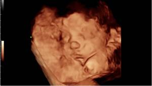 3D ultrasound image of unborn baby showing facial features in womb