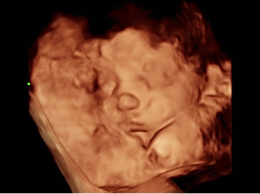 3D ultrasound image of unborn baby showing facial features in womb
